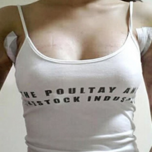 三亞圣迪亞整形美容醫(yī)院醫(yī)生韓超做假體隆胸怎么樣？附案例效果對(duì)比圖