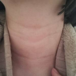 昭通愛麗諾整形醫(yī)生陳志江做嗨體去頸紋怎么樣？附案例效果圖