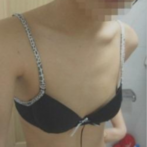 三亞圣迪亞整形美容醫(yī)院醫(yī)生韓超做假體隆胸怎么樣？附案例效果對(duì)比圖