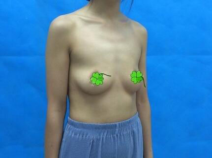 海南伊佳醫(yī)療美容醫(yī)院醫(yī)生涂陽君做假體隆胸怎么樣？附案例效果對(duì)比圖