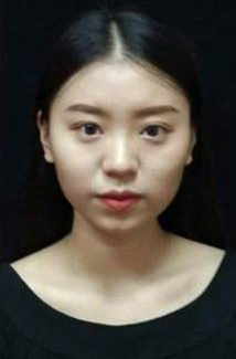 長沙星雅醫(yī)療美容醫(yī)院醫(yī)生陳煥武做埋線提升怎么樣？