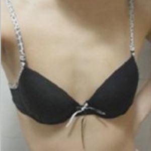 三亞圣迪亞整形美容醫(yī)院醫(yī)生韓超做假體隆胸怎么樣？附案例效果對(duì)比圖