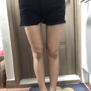 貴陽(yáng)華美整形美容醫(yī)院醫(yī)生田永華做大腿吸脂效果怎么樣？附大腿吸脂案例前后對(duì)比圖