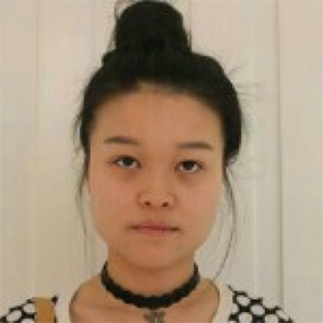 鄭州管城中醫(yī)院整形美容中心醫(yī)生張秀英做注射瘦臉怎么樣？附除皺瘦臉案例效果圖