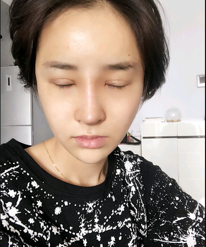 武漢米蘭醫(yī)療美容醫(yī)生柳再億做眼綜合+鼻綜合整形怎么樣？附真實案例對比圖