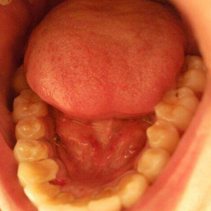 淄博口腔醫(yī)院醫(yī)生牟象鑫做超聲波洗牙怎么樣？附案例效果對比圖