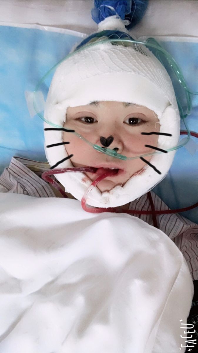 北京彤美美容整形醫(yī)院醫(yī)生楊曉惠做顴骨內推+面部吸脂手術效果怎么樣？附案例