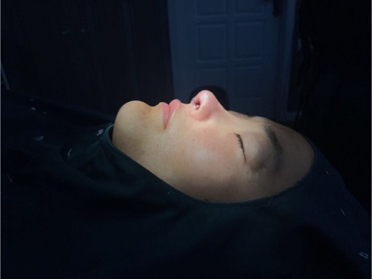 北京集美名媛醫(yī)療整形醫(yī)生陳瀅雯做自體耳軟骨隆鼻怎么樣？附案例效果圖