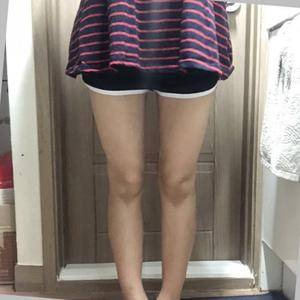 貴陽(yáng)華美整形美容醫(yī)院醫(yī)生田永華做大腿吸脂效果怎么樣？附大腿吸脂案例前后對(duì)比圖