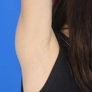 重慶中成整形美容醫(yī)院醫(yī)生田忠成激光脫腋毛效果怎么樣？附案例效果圖