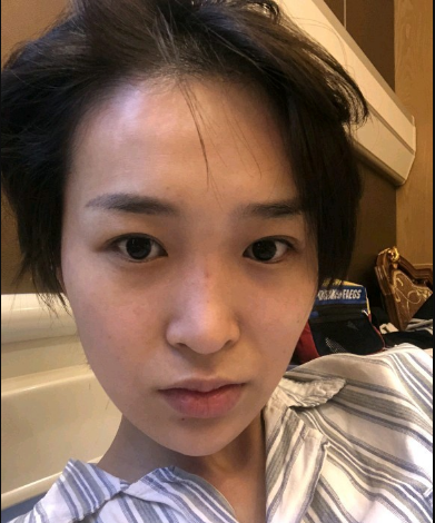 武漢米蘭醫(yī)療美容醫(yī)生柳再億做眼綜合+鼻綜合整形怎么樣？附真實案例對比圖
