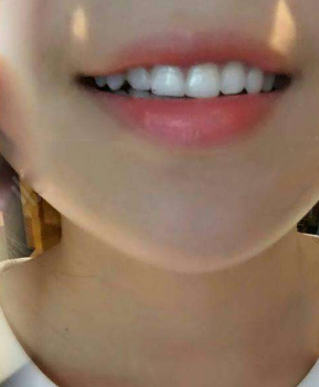 淄博口腔醫(yī)院醫(yī)生牟象鑫做超聲波洗牙怎么樣？附案例效果對(duì)比圖