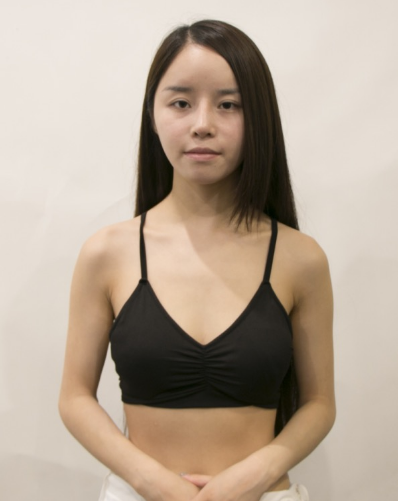 吉林現(xiàn)代整形美容醫(yī)院做假體隆胸效果怎么樣？附醫(yī)院案例效果對(duì)比圖