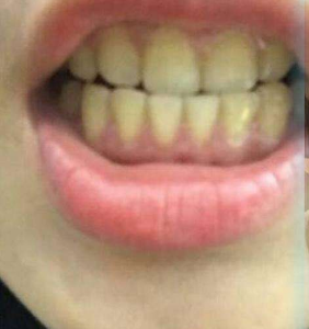 淄博口腔醫(yī)院醫(yī)生牟象鑫做超聲波洗牙怎么樣？附案例效果對比圖