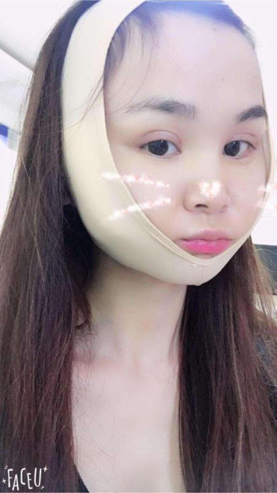 北京彤美美容整形醫(yī)院醫(yī)生楊曉惠做顴骨內(nèi)推+面部吸脂手術(shù)效果怎么樣？附案例