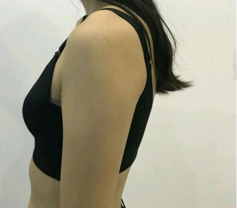 武漢伽美醫(yī)療美容醫(yī)院醫(yī)生朱富初做自體脂肪隆胸怎么樣？看案例