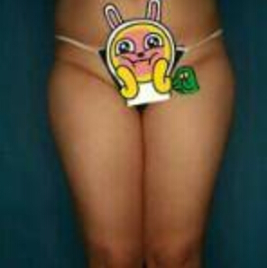 貴陽華美整形美容醫(yī)院醫(yī)生田永華做大腿吸脂效果怎么樣？附大腿吸脂案例前后對比圖