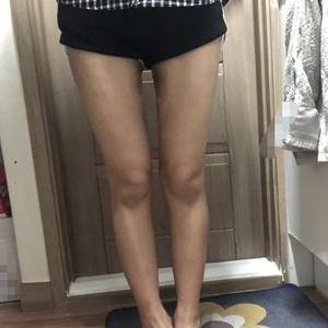 貴陽(yáng)華美整形美容醫(yī)院醫(yī)生田永華做大腿吸脂效果怎么樣？附大腿吸脂案例前后對(duì)比圖