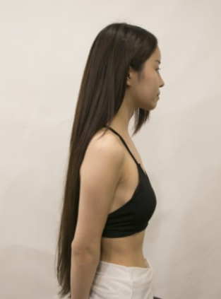 吉林現(xiàn)代整形美容醫(yī)院做假體隆胸效果怎么樣？附醫(yī)院案例效果對(duì)比圖