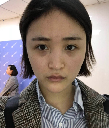 北京伊美爾美容愛康醫(yī)院醫(yī)生柳成做鼻綜合整形怎么樣？附案例效果圖