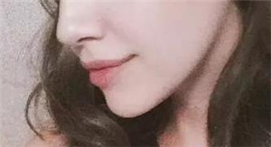 深圳陽(yáng)光整形美容醫(yī)院隆鼻修復(fù)