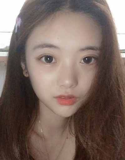 合肥韓美整形醫(yī)院做雙眼皮效果怎么樣?附石顯武醫(yī)生案例