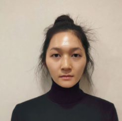 上海時(shí)光整形醫(yī)院做面部玻尿酸注射效果怎么樣？