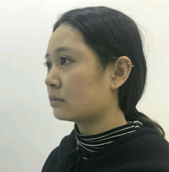 上海時光整形醫(yī)院做豐下巴怎么樣？許黎平醫(yī)生豐下巴案例分享