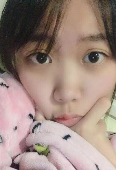 合肥韓美整形美容醫(yī)院做去眼袋效果怎么樣?附金壽信醫(yī)生去眼袋案例效果圖 合肥韓美整形美容醫(yī)院做去眼袋效果怎么樣?附金壽信醫(yī)生去眼袋案例效果圖