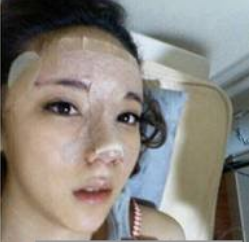 上海時(shí)光整形醫(yī)生何晉龍做假體隆鼻效果怎么樣？附案例效果對(duì)比圖