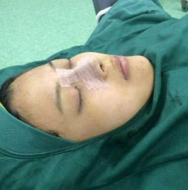 合肥韓美整形醫(yī)院做隆鼻手術(shù)效果怎么樣?附劉冷醫(yī)生隆鼻案例效果圖 合肥韓美整形醫(yī)院做隆鼻手術(shù)效果怎么樣?附劉冷醫(yī)生隆鼻案例效果圖