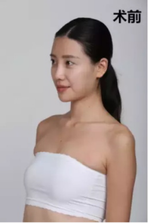 上海時(shí)光整形醫(yī)院何晉龍醫(yī)生做假體隆胸怎么樣？附案例對(duì)比圖