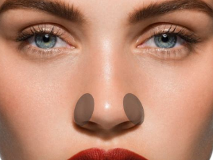 海南華美醫(yī)學(xué)美容醫(yī)院鼻翼縮小