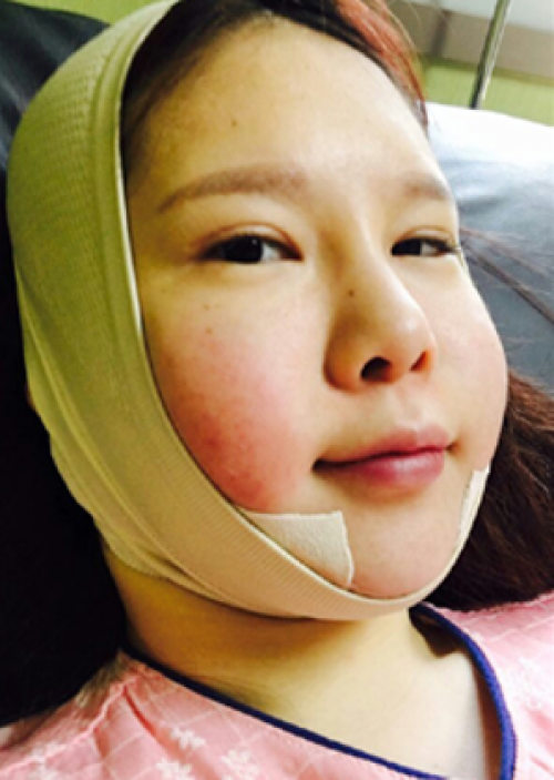 安康希顏醫(yī)療整形醫(yī)生王奇效做面部吸脂案例效果對比圖