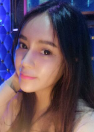 鞍山王景醫(yī)療美容外科診所做自體脂肪豐蘋果肌效果怎么樣？附張婉鸝案例效果圖