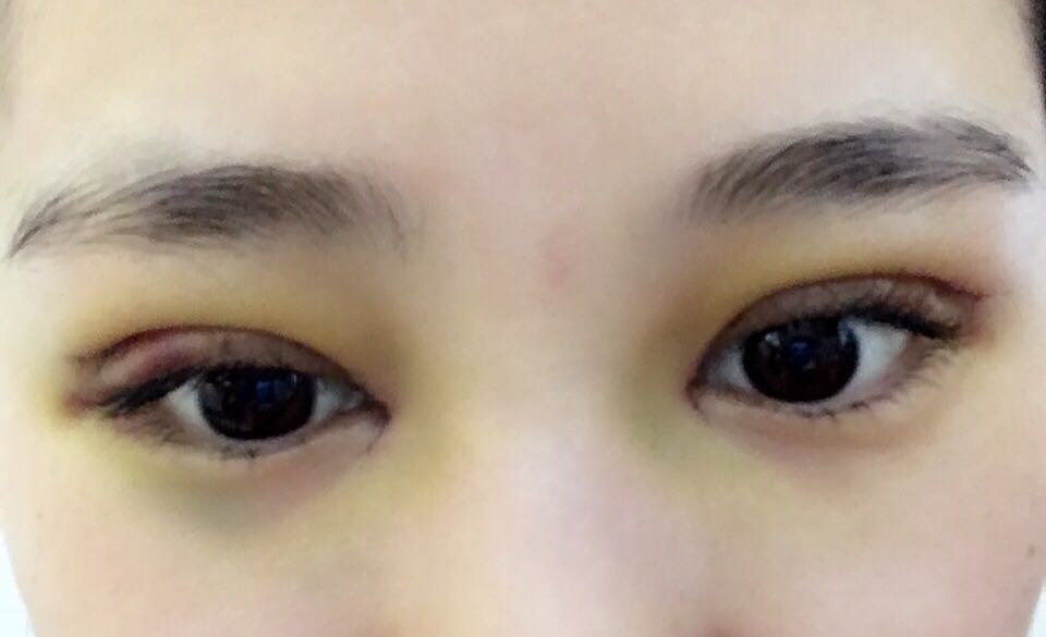 蚌埠韓美美萊整形醫(yī)生鄭捷做開(kāi)眼角怎么樣？附案例效果圖