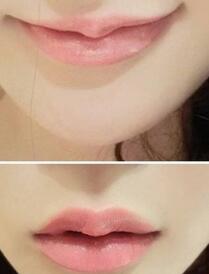 巴中時光醫(yī)學(xué)美容門診部做玻尿酸豐唇效果怎么樣？附李紅強豐唇案例