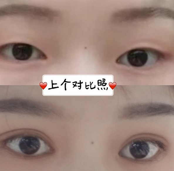 鞍山菲之都醫(yī)療整形醫(yī)院做開眼角+全切雙眼皮效果怎么樣？附藺嬌婷醫(yī)生案例