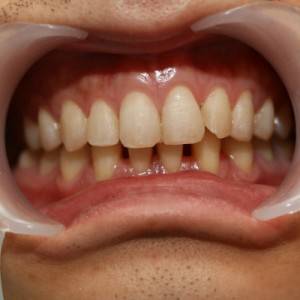 鞍山時代口腔門診部做瓷貼面案例效果圖 鞍山時代口腔門診部做瓷貼面案例效果圖