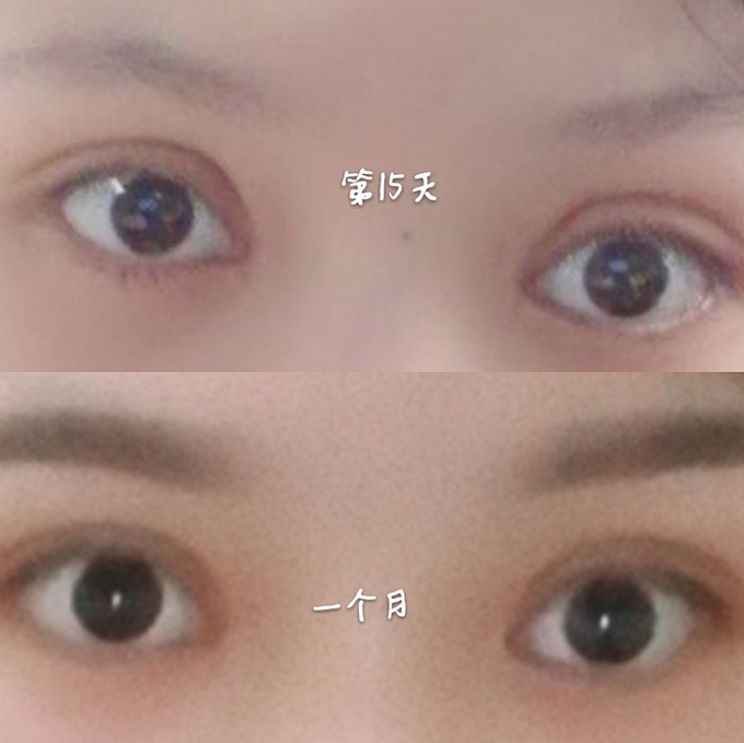 雙眼皮案例效果對(duì)比照