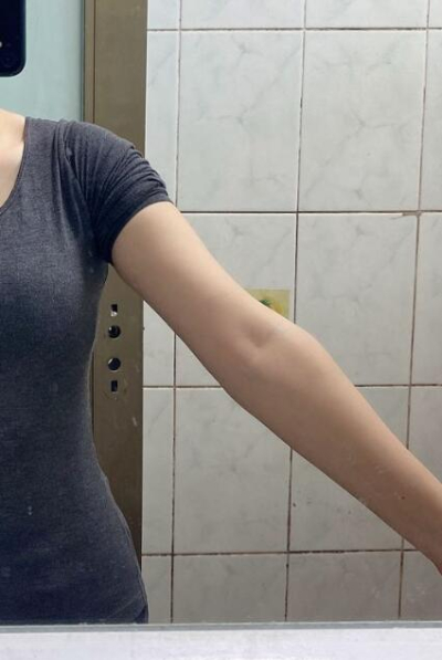 蚌埠市第三人民醫(yī)院燒傷整形科楊蔚做手臂吸脂效果對比圖