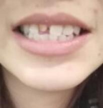 鞍山時代口腔門診部劉昕醫(yī)生做美容冠效果怎么樣？一起來看看吧