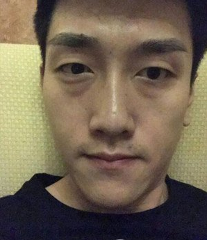 鞍山燕麗醫(yī)療美容醫(yī)院薛媚醫(yī)生做去眼袋效果怎么樣？附案例效果對比圖