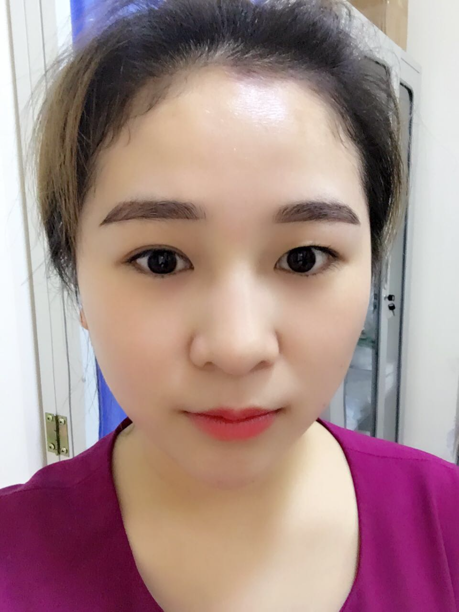 蚌埠韓美美萊整形醫(yī)生鄭捷做開眼角怎么樣？附案例效果圖