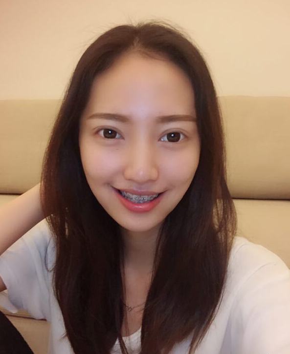 巴中華醫(yī)口腔醫(yī)院做牙齒矯正效果好嗎？附母汶靈醫(yī)生牙齒矯正案例效果圖