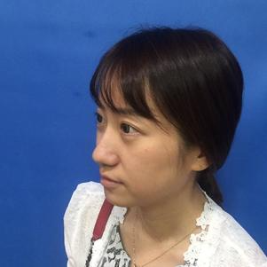 蚌埠韓美美萊整形做玻尿酸面部除皺效果怎么樣？附陳澤醫(yī)生案例效果圖