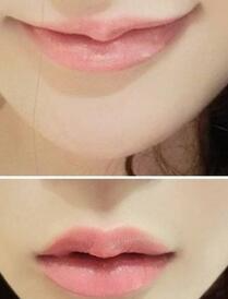 巴中時光醫(yī)學美容門診部做玻尿酸豐唇效果怎么樣？附李紅強豐唇案例