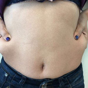 蚌埠韓美美萊整形醫(yī)生張濤做水動(dòng)力吸脂怎么樣？附吸脂案例效果圖