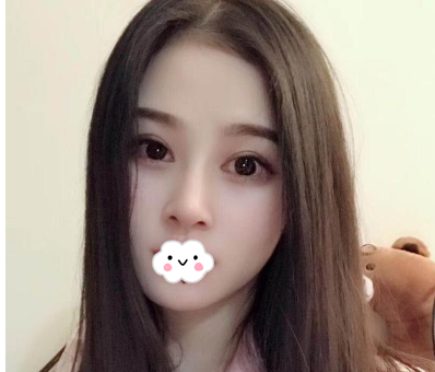 蚌埠韓美美萊整形醫(yī)生歷芳做耳軟骨隆鼻怎么樣？附耳軟骨隆鼻案例對(duì)比圖