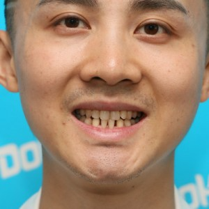 鞍山時代口腔門診部做瓷貼面怎么樣？附孫興國醫(yī)生瓷貼面案例效果圖